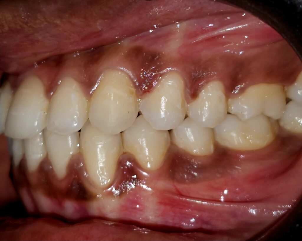CLASS 3 MANDIBLE ORTHODONTIC CORRECTION POST 2