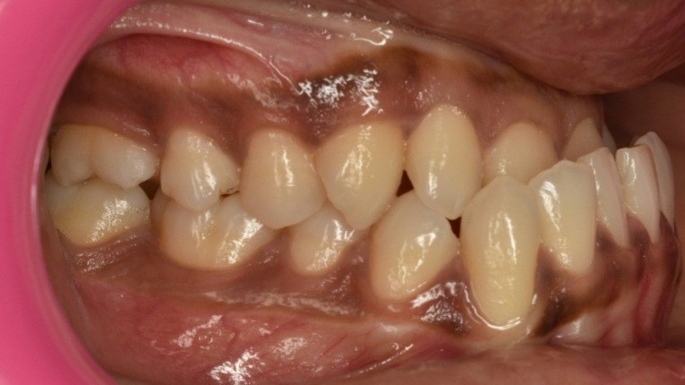 CLASS 3 MANDIBLE ORTHODONTIC CORRECTION PRE
