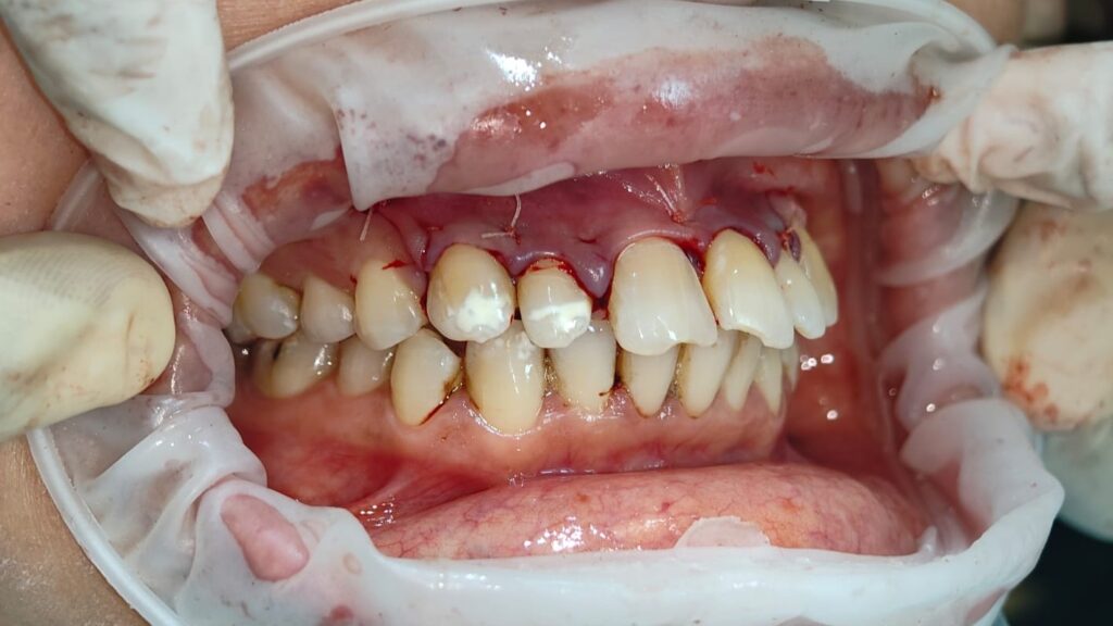 CYST SURGERY POST