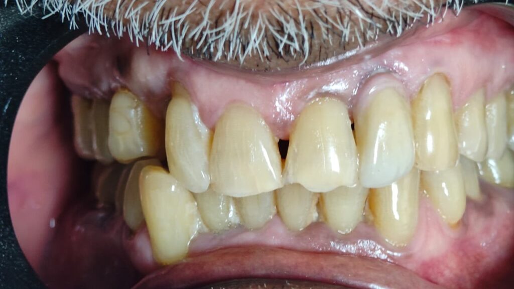 DENTAL IMPLANT POST