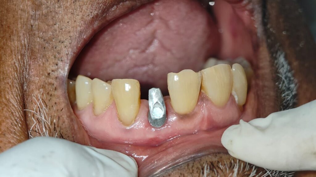 DENTAL IMPLANT PRE