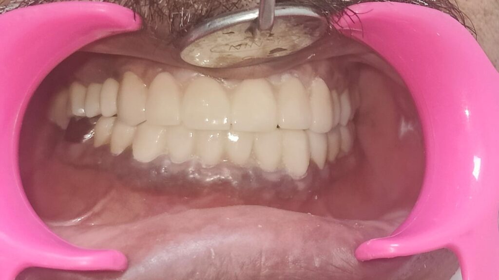 FULL MOUTH REHAB POST