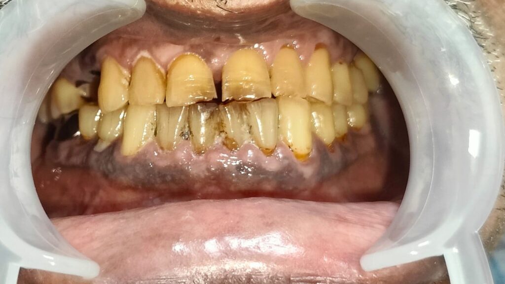 FULL MOUTH REHABLITATION