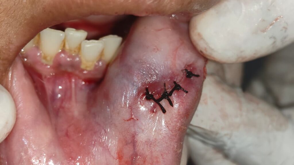 MUCOCELE LIP