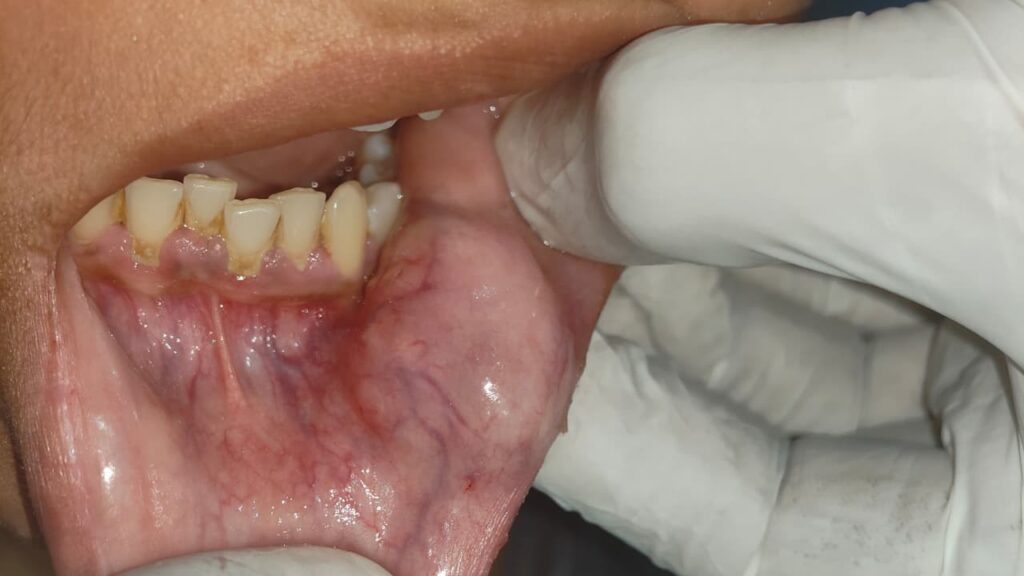 MUCOCELE LIP PRE